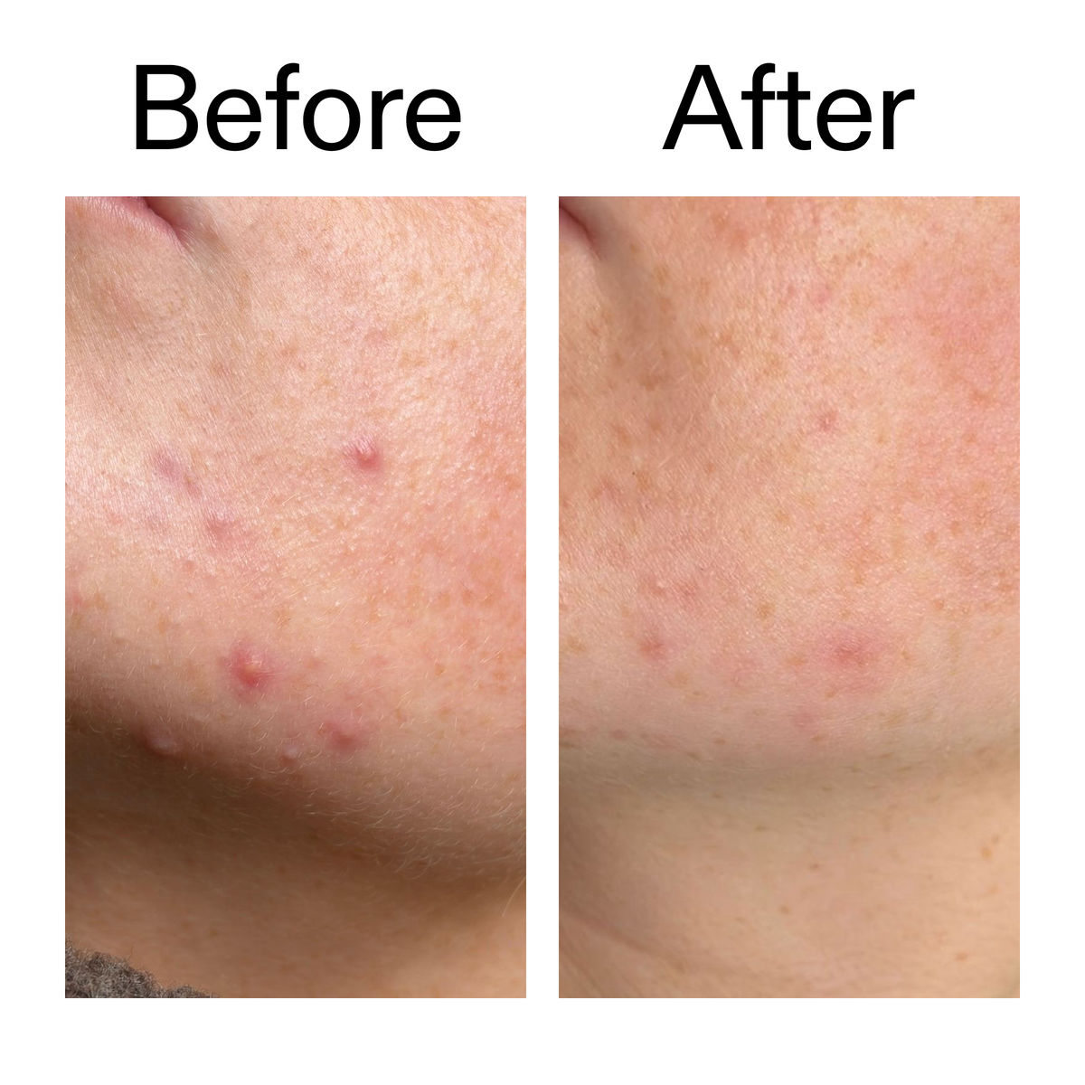 10-azelaic-acid-serum-for-redness-relief-f9 B_A_1_PPAGE.png