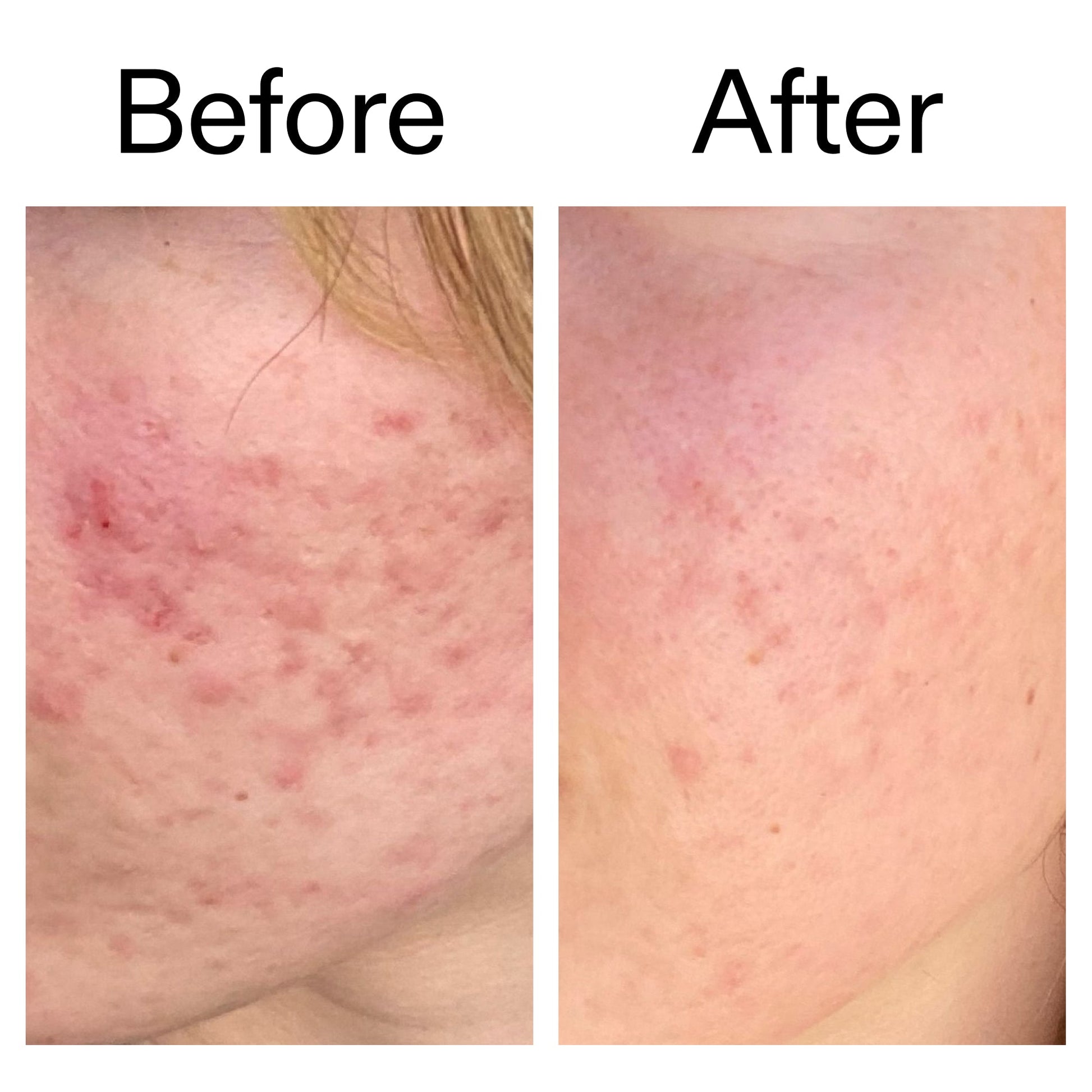 10-azelaic-acid-serum-for-redness-relief-f9 Azealic_Acid_Serum_B_A_Ppage_2000_x_2000.jpg