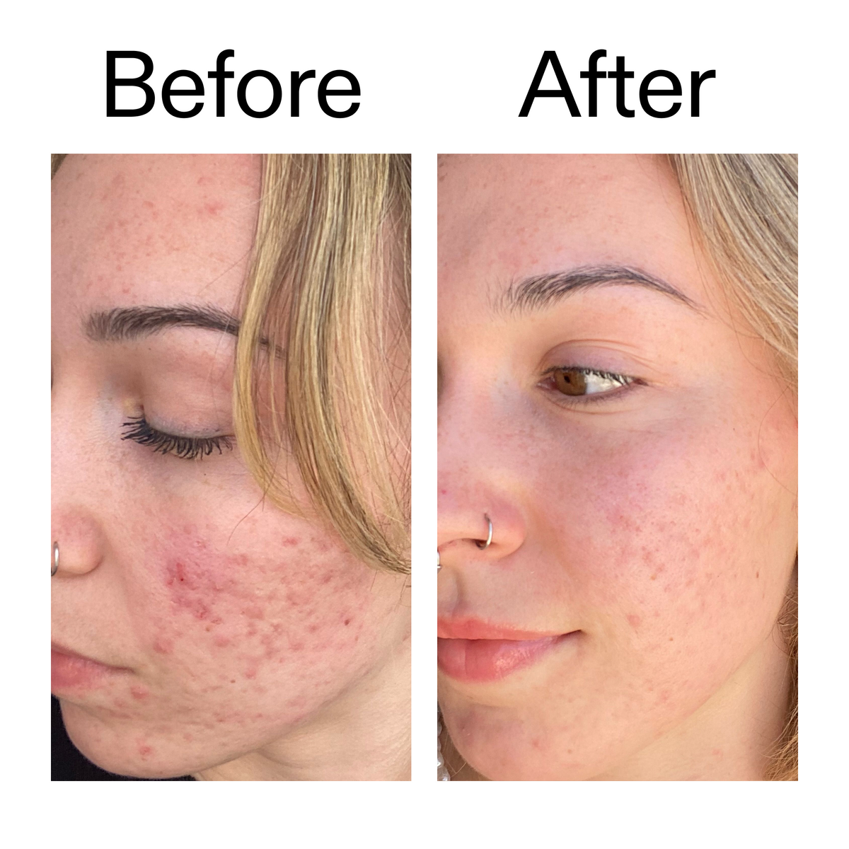10-azelaic-acid-serum-for-redness-relief-f9 B_A_2_PPAGE.png