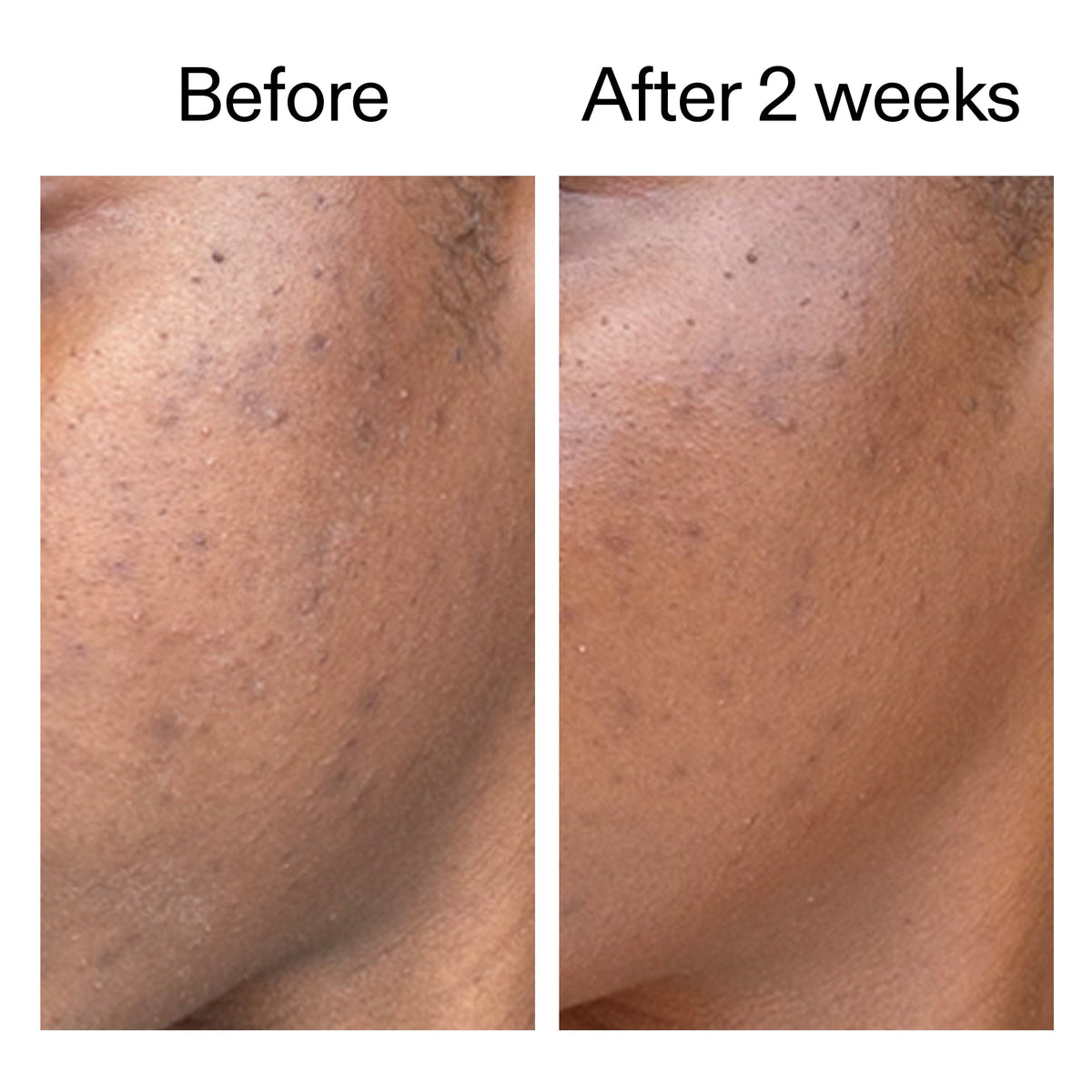 360-acne-clearing-duo-x6 DIOICB_A2000x2000.jpg