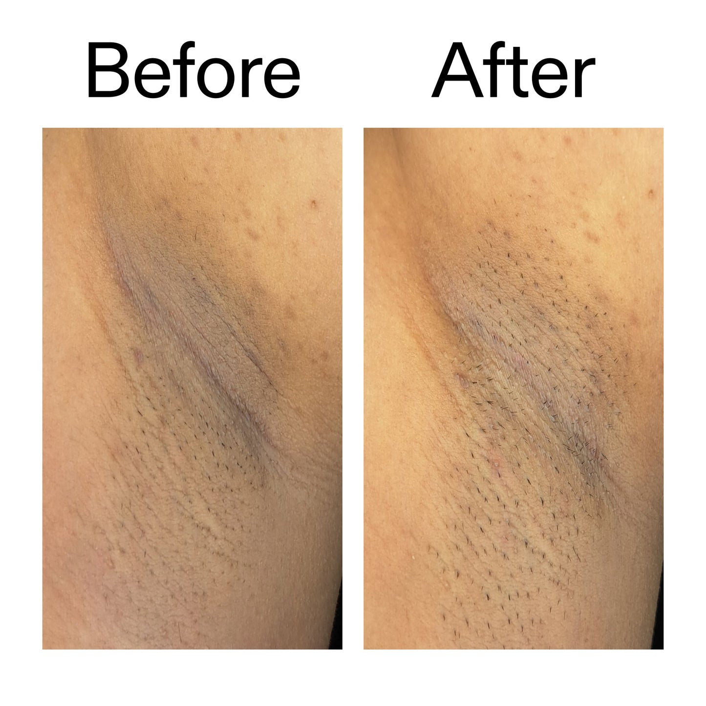 glycolic-acid-exfoliating-body-stick-u8 Glycolic_Acid_Exfoliating_Body_Stick_Before_After_V3_2000x2000_ea919cd9-1439-4a46-82a0-76200eb5bb42.jpg