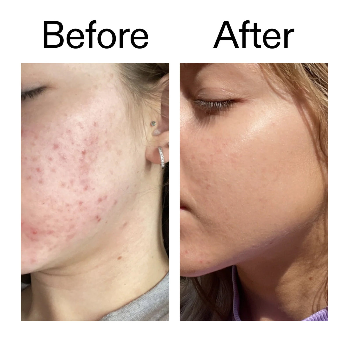 10-niacinamide-serum-duo-z1 Niacinamide_Serum_Before_After_2000x2000_bde32455-9e7d-448e-b053-bef41504f0a9.jpg