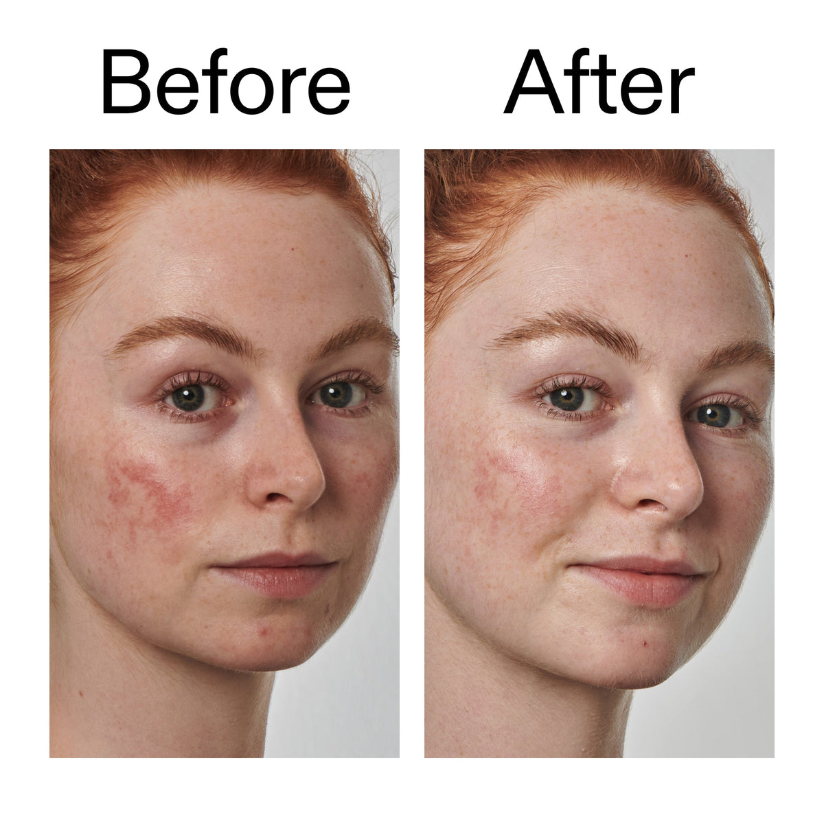 10-azelaic-acid-serum-for-redness-relief-f9 Redness_Relief_Serum_Before_After_2000x2000_3334dc9a-cce9-4e00-8aec-7ad89ca051f2.jpg