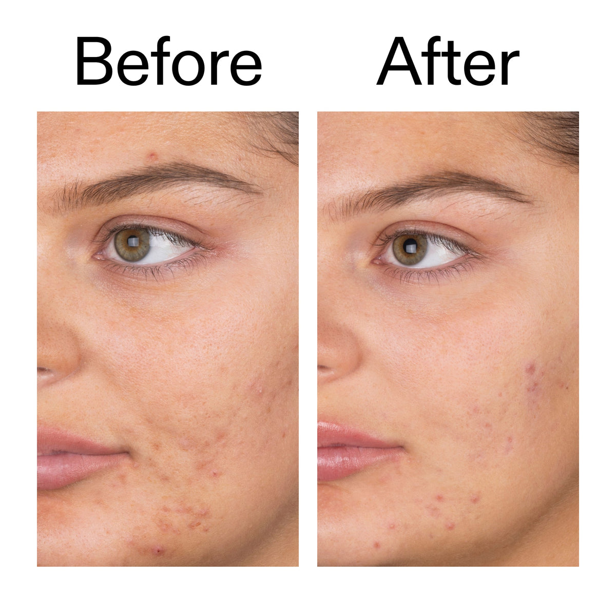 salicylic-acid-cleanser-150ml-w7 Salicylic_Acid_Cleanser_-_150ml_Before_After_2000x2000_e7230494-853f-4b07-82b1-27669104c995.jpg