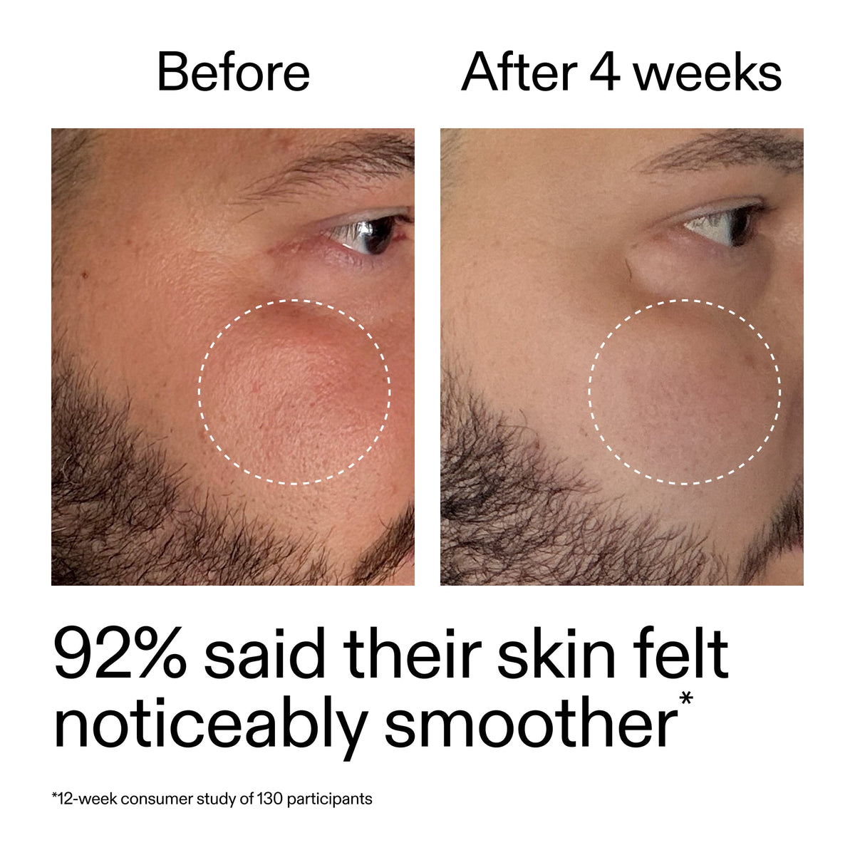 starter-retinol-serum-l3 StarterRetinol_BeforeAfter_Claim3_2000x2000_6ceab106-e0ee-4ed4-ba62-41bc39538038.jpg